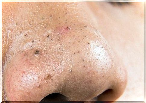 5 homemade remedies for blackheads