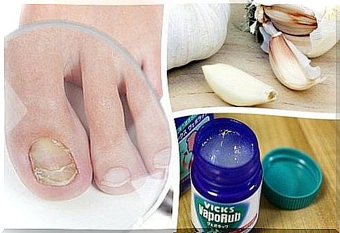 7 homemade remedies against nail fungus