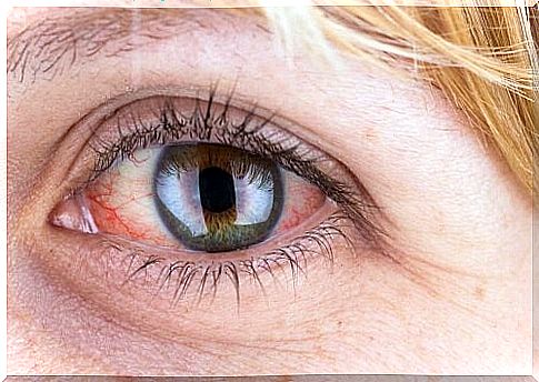 Woman with eye inflammation