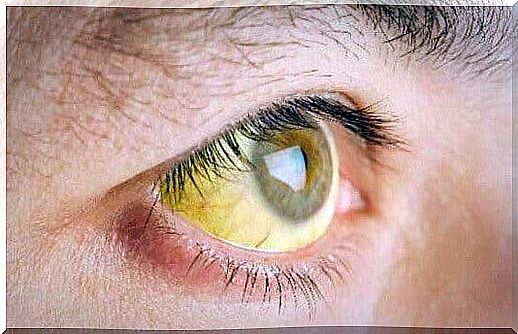 Yellow eyes are a sign of toxins in the liver.