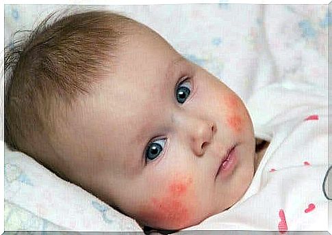 Girl with atopic eczema in babies