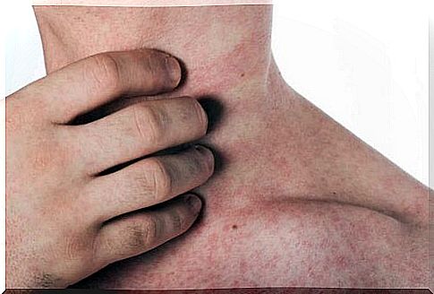 A person with a latex allergy has a rash on the throat