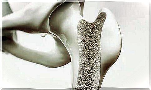 Bone with osteoporosis