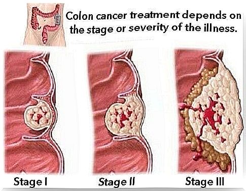 Home treatment for ulcerative colitis