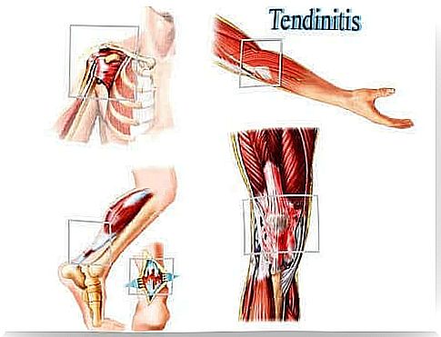 Tendinitis is an irritation of the tendon