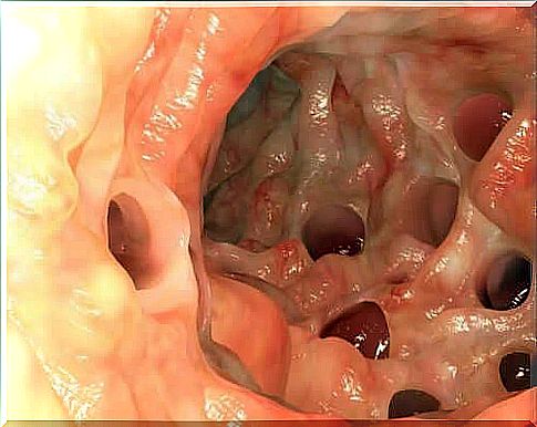 Meckel's diverticulum and its characteristics