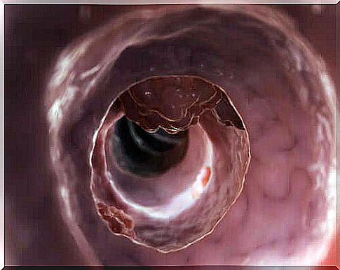 Meckel's diverticulum consists of the same three layers that make up the small intestine