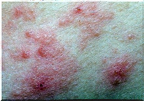 dermatitis and sensitive skin