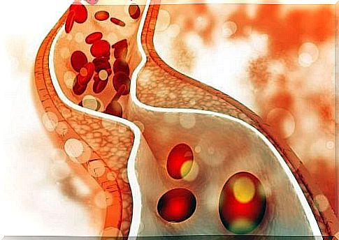 Blood vessels with high cholesterol content