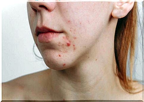 Blackheads and pimples are the main symptoms of acne