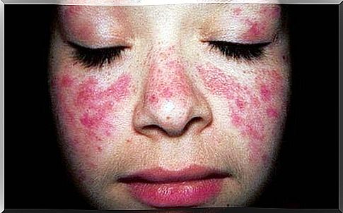 Treatment of lupus erythematosus (SLE)