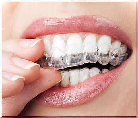 Woman uses transparent braces