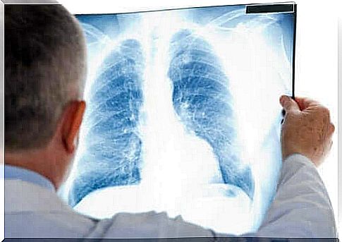 What is cold pneumonia?