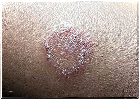 What is ringworm and how to treat it