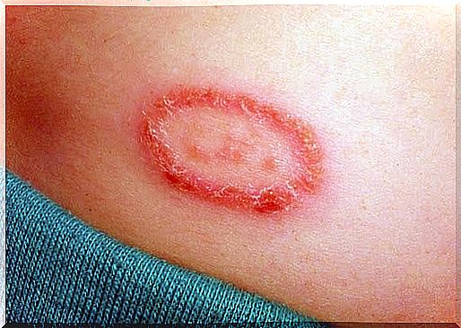 causes and treatment of ringworm