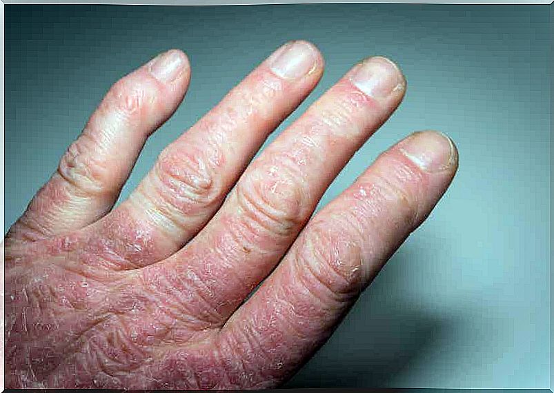 A person with extremely dry and red skin on the hand